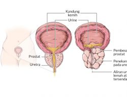 Mengenali Gejala Penyakit Prostat: Pentingnya Deteksi Dini