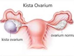 Operasi Kista Ovarium: Prosedur, Risiko, dan Pemulihan yang Perlu Diketahui